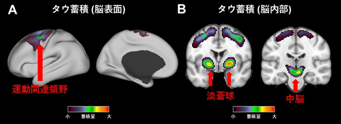 タウPETによるタウ蓄積脳部位の同定