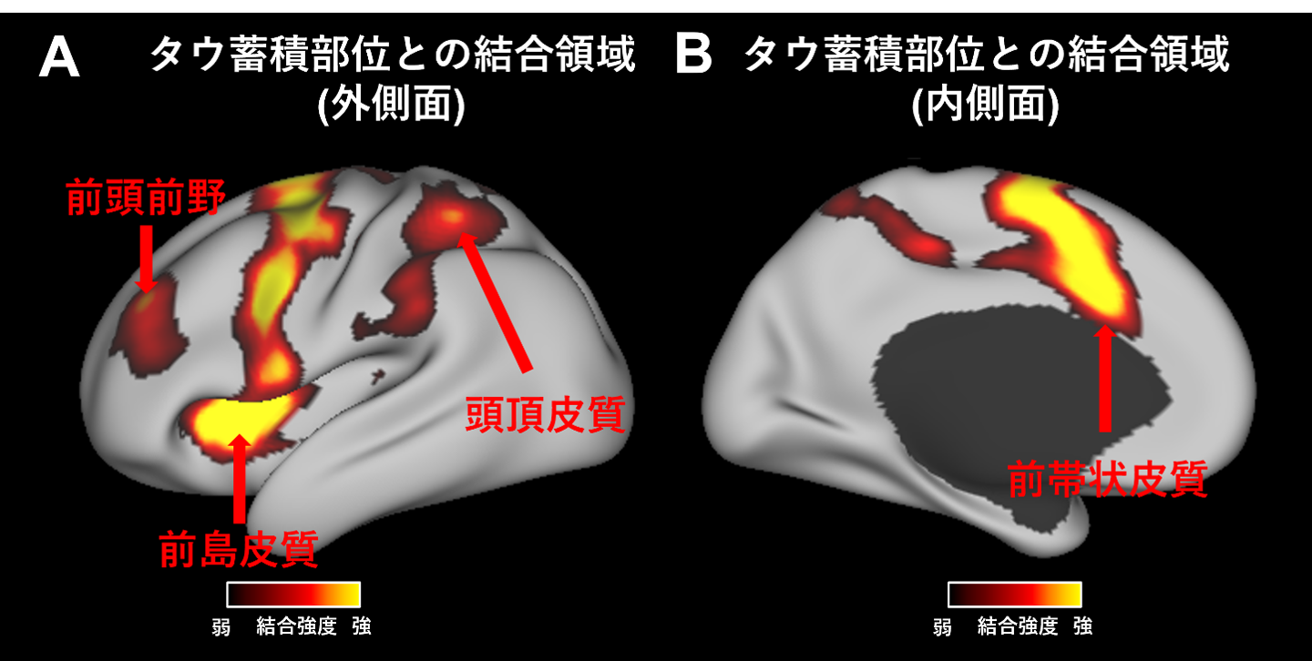 機能的MRI解析による、患者間で共通してタウ蓄積部位からつながっている 「PSP-タウ・ネットワーク」の同定