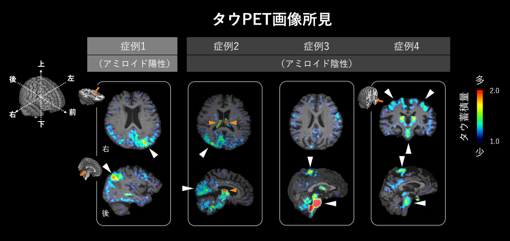 中高年の精神症患者にみられるさまざまなタウ蓄積のパターン