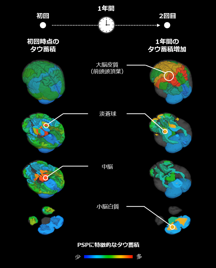 PSPに特徴的なタウ蓄積領域