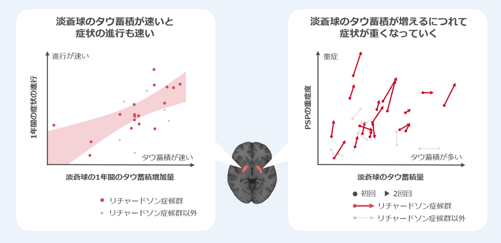 淡蒼球におけるタウ蓄積の経時変化と症状進行との関係