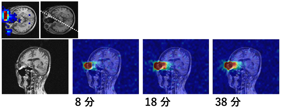 H217Oを点眼しながら撮影したMRI画像